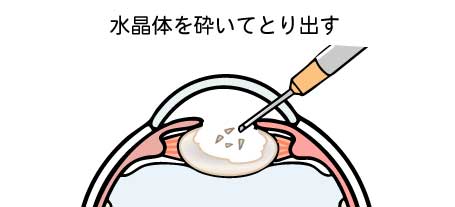 水晶体を砕いて吸い出す