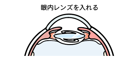 眼内レンズを入れる